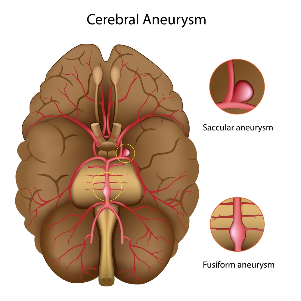 cerebral aneurysm.jpg